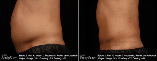 12 weeks after 2 Tx of SculpSure body contouring/body sculpting sessions for flanks and abdomen