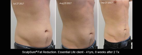8 weeks after 2 Tx of SculpSure body contouring/body sculpting sessions for abdomen