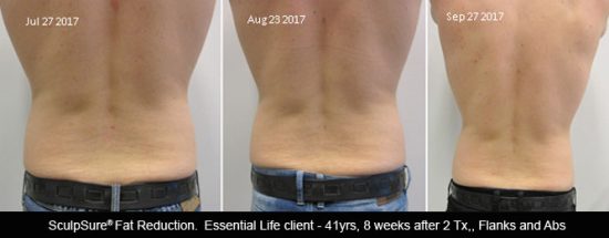 8 weeks after 2 Tx of SculpSure body contouring/body sculpting sessions for flanks
