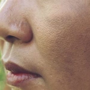 Dull and dry skin