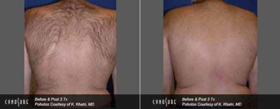 Laser Hair Removal Toronto - Back