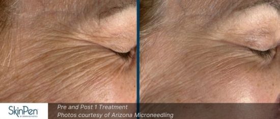 Microneedling before and after