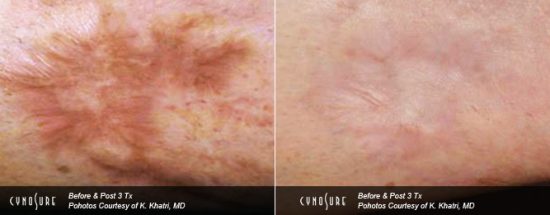 Keloid scar treatment