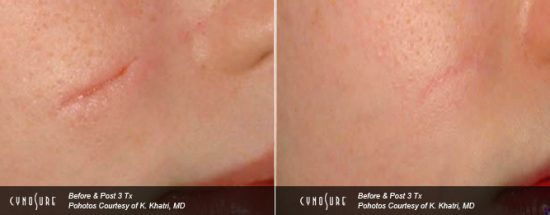 hypertrophic cheek scar treatment