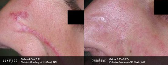 face scar treatment