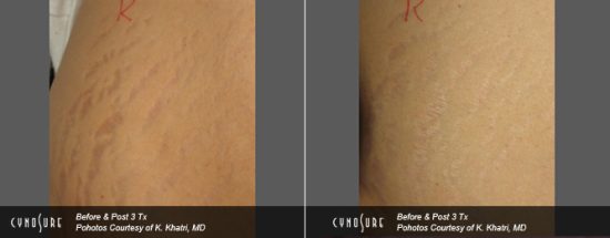 stretch marks treatment