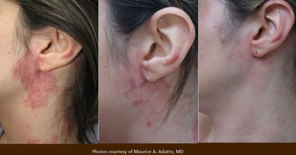 Port Wine Stain Treatment - 2 Tx - 6 weeks and 12 weeks after