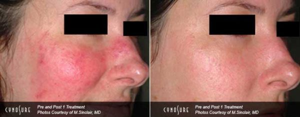 Rosacea Treatment