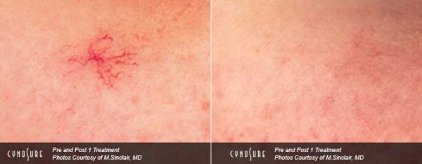 Spider Angioma Treatment
