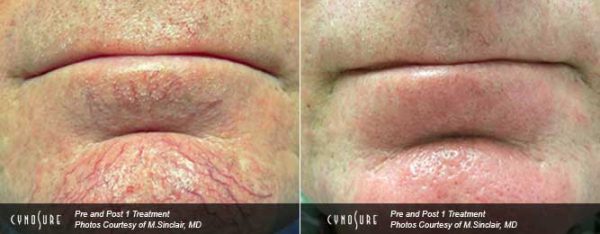 Telangiectasia (facial spider veins) Treatment