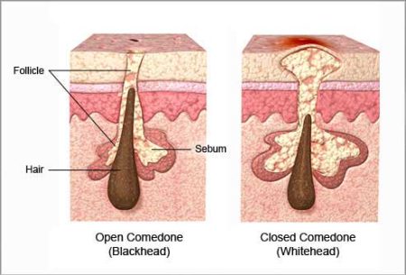 acne-open-and-closed-comedones