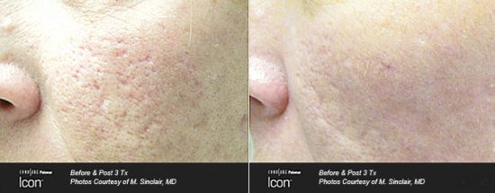 acne scar treatment