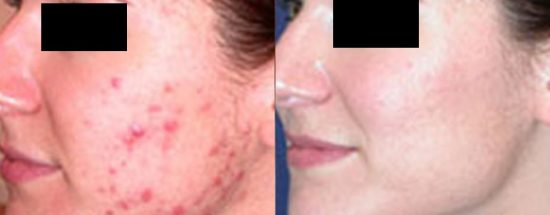 acne on face