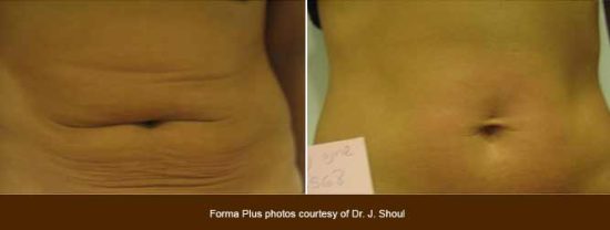 Body Skin Tightening - Stomach