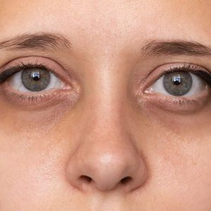 Dark circles under eyes