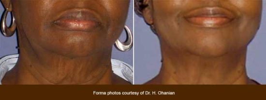 Skin Tightening for Loose Neck Skin