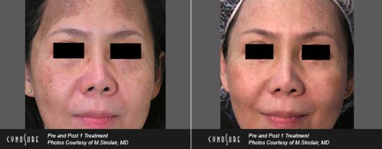 melasma hyperpigmentation treatments in Toronto