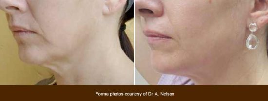 Non-surgical Face Lift