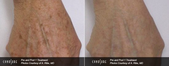liver spots treatment in Toronto