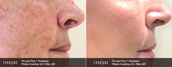 hyperpigmentation age spots treatment in Toronto