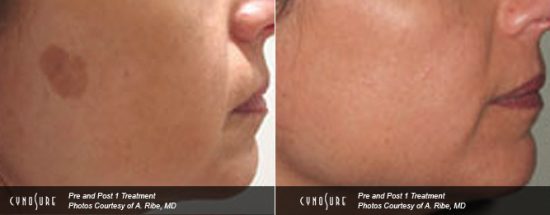 keratosis skin pigmentation treatments in Toronto