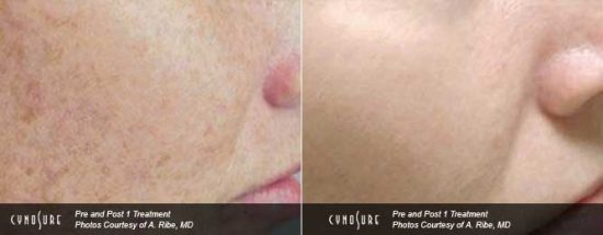 hyperpigmentation sun spots treatment in Toronto