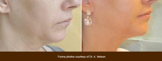 Skin Tightening Toronto