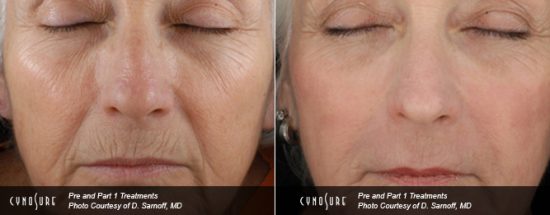 Laser skin resurfacing before and after